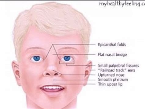 what is prader willi syndrome